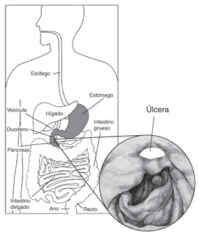 Descripci�n: Dibujo del aparato digestivo en la que se se�alan el es�fago, est�mago, h�gado, ves�cula, duodeno, p�ncreas, intestino delgado, intestino grueso, recto y ano. Un dibujo agrandado del est�mago muestra una �lcera p�ptica en la que se se�ala la �lcera.